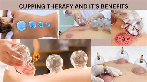 Cupping Therapy